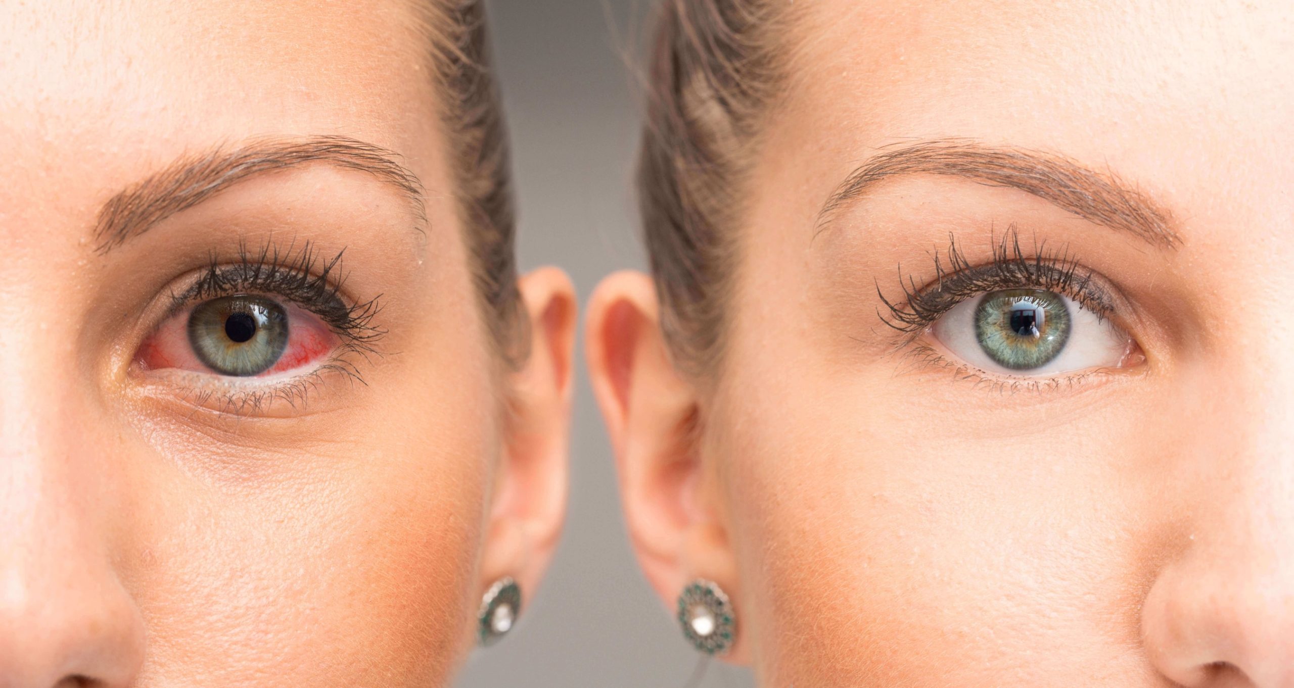 Close-up of a red, inflamed eye