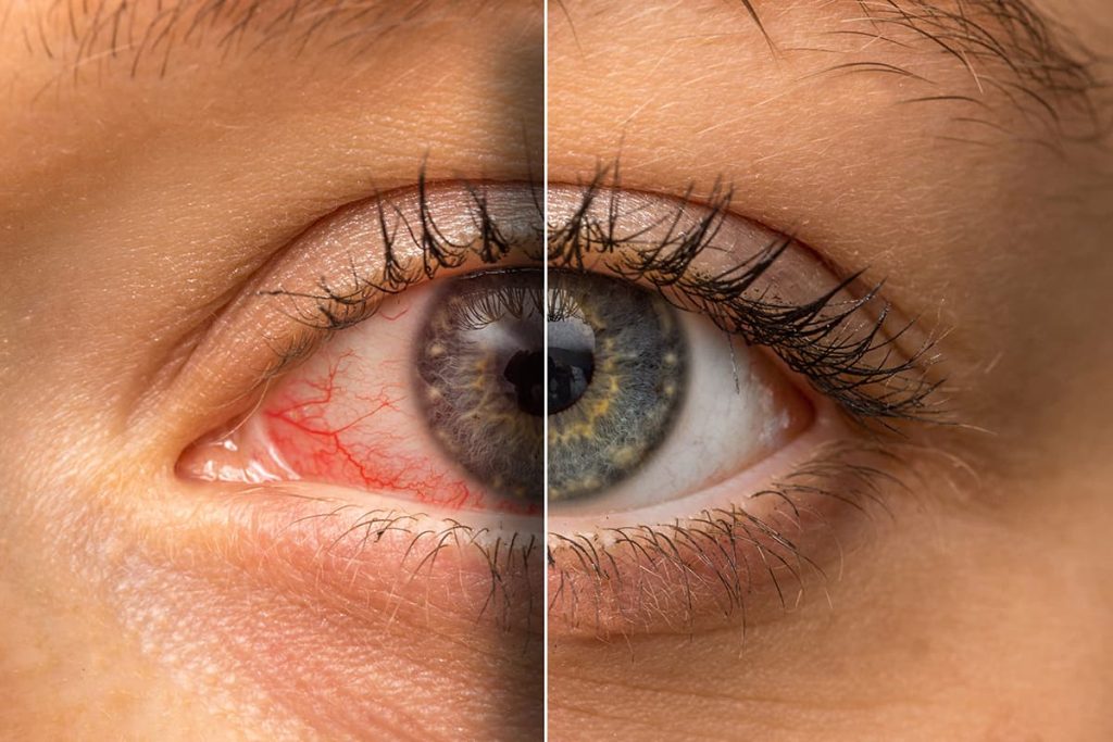 When to Seek Help for Eye Allergies? Warning Signs You Need an Optometrist