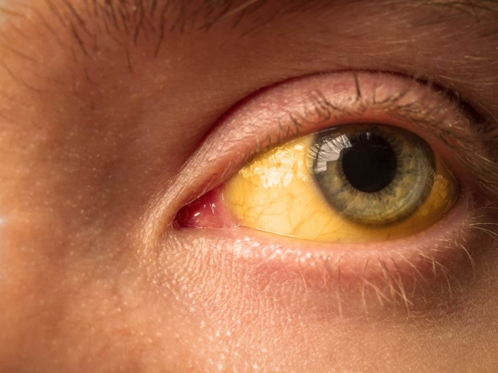 What Causes Yellow Eyes?